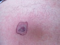 brown recluse bite 52 hours.jpg