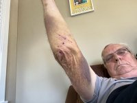 ARM-BRUISE.jpg